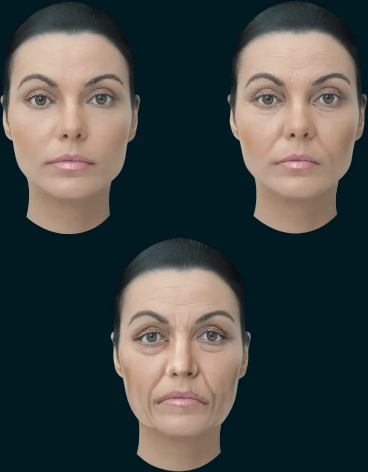 Fig 6. Progression of facial aging in the same face